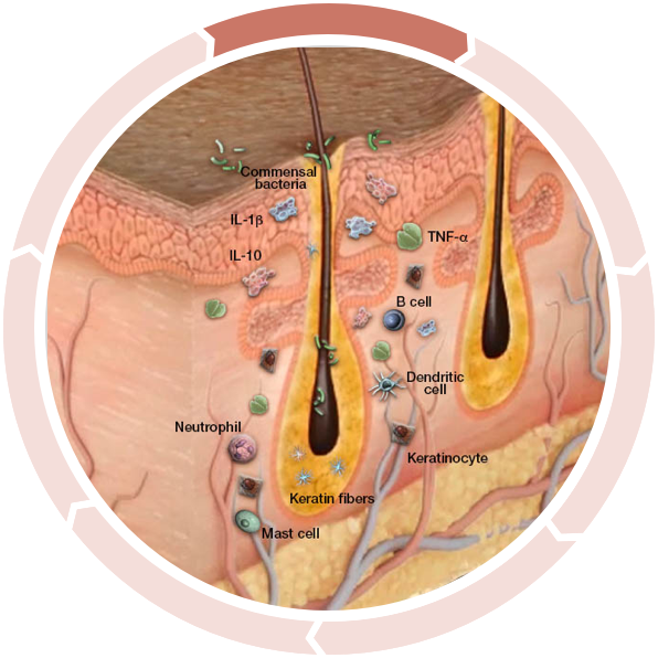 Cycle of inflammation in hidradenitis suppurativa: Increased inflammation activation