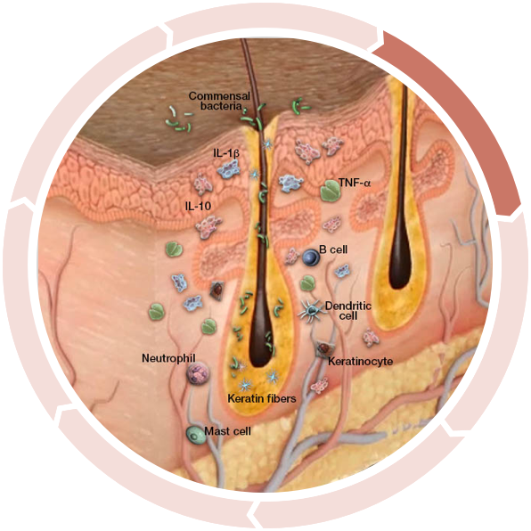 Increased anti-inflammatory cytokines Cycle of inflammation in hidradenitis suppurativa: Increased anti-inflammatory cytokines