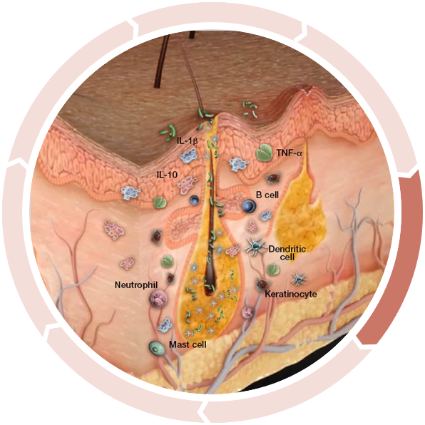 Cycle of inflammation in hidradenitis suppurativa: Altered anti-microbial peptide production