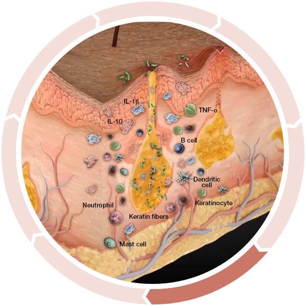 Cycle of inflammation in hidradenitis suppurativa: Decreased antibacterial defense