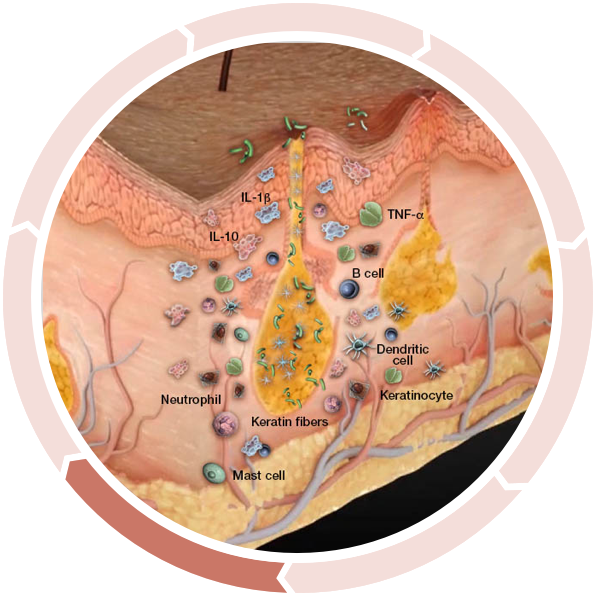 Cycle of inflammation in hidradenitis suppurativa: Follicular Occlusion