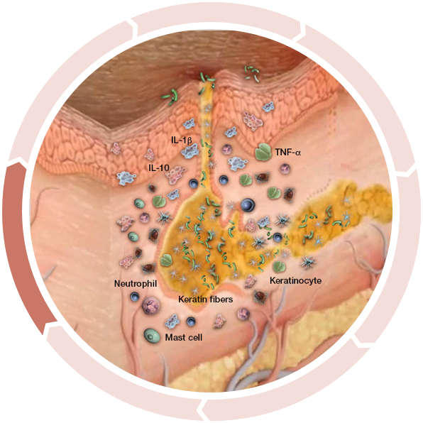 Follicular dilation and rupture Cycle of inflammation in hidradenitis suppurativa: Follicular dilation and rupture