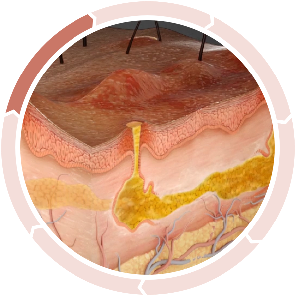 Nodule and abscess formation Cycle of inflammation in hidradenitis suppurativa: Nodule and abscess formation