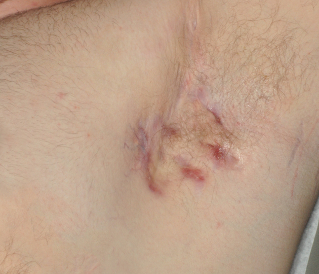 Image of Hurley Stage II (moderate) underarm