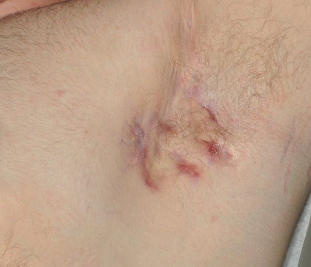 Hurley Stage II Image of Hurley Stage II (moderate) underarm
