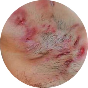 HS Hurley Stage II Hidradenitis suppurativa Hurley Stage II underarm
