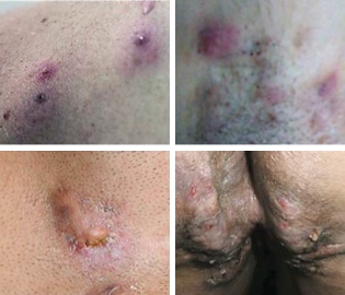 Types of lesions Hidradenitis suppurativa early stage with swollen bumps underarm