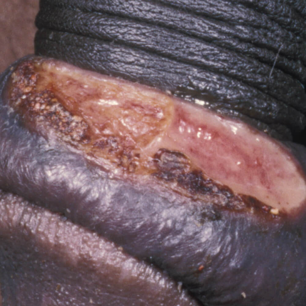 Lymphogranuloma venereum Lymphogranuloma venereum