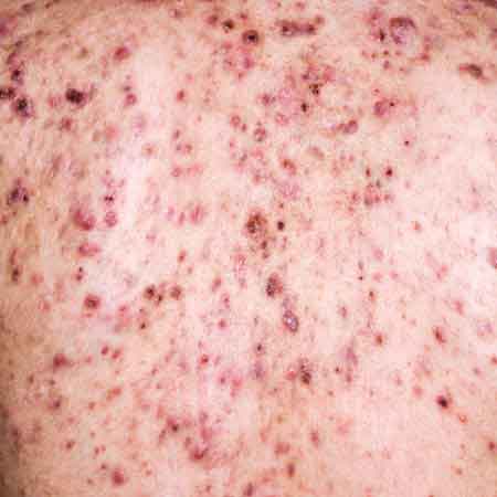 Cystic acne Acne, cystic acne
