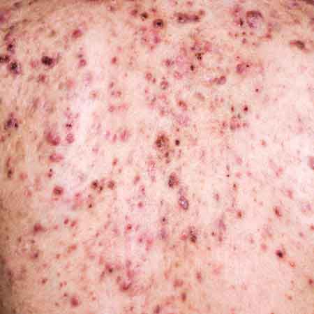 Acne, cystic acne