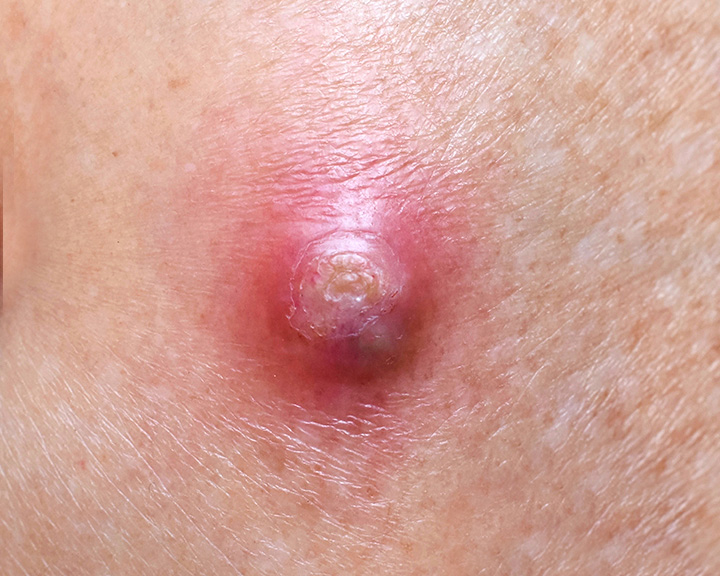 Boil Follicular pyodermas (carbuncles, furuncles,boils)