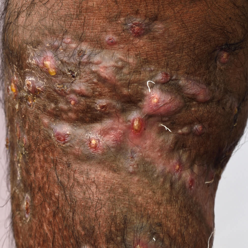 Actinomycosis Actinomycosis