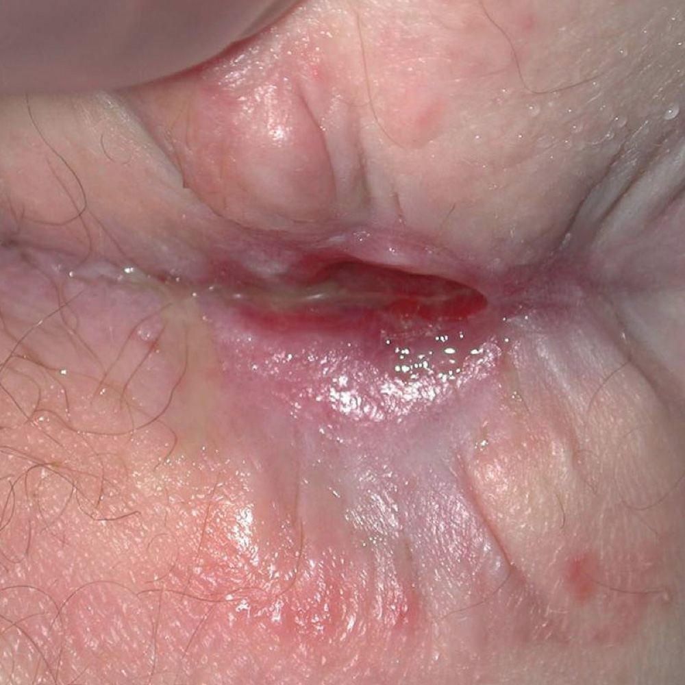 Cutaneous Crohn's disease Cutaneous Crohn's disease