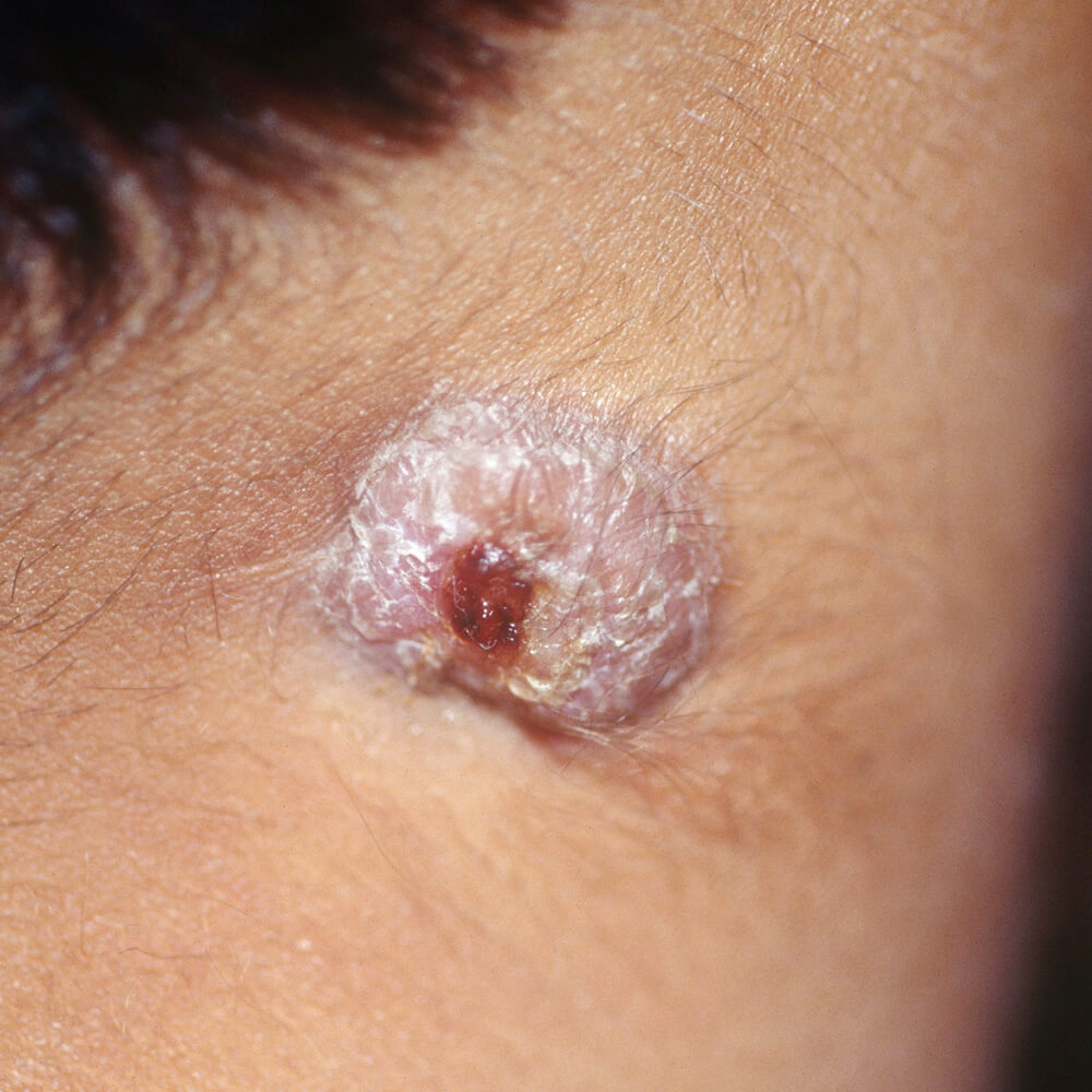 Tuberculosis verrucosa cutis Cutaneous tuberculosis