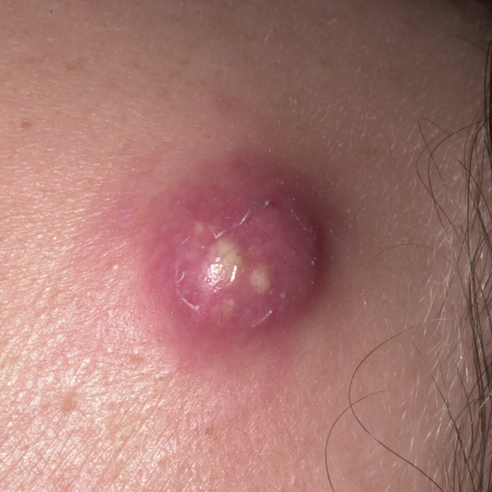 Epidermoid cyst Other considerations, for example, epidermoid or dermoid cyst, pilonidal cyst, erysipelas