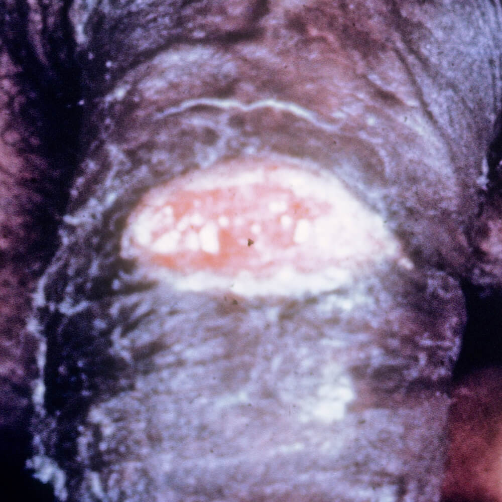 Granuloma inguinale Granuloma inguinale
