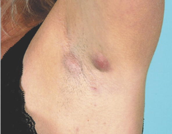 Image of Hurley Stage I (mild) underarm