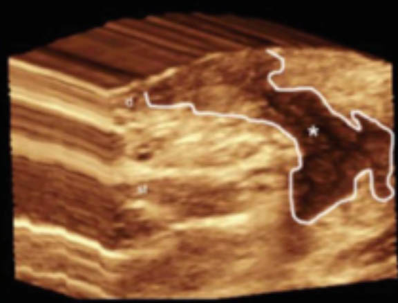 Sinus tract 3D ultrasound hidradenitis suppurativa image demonstrates a sinus tract that affects the dermis and subcutaneous tissue