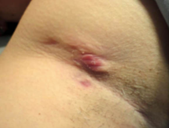 Hurley Stage II Clinical image of a hidradenitis suppurativa underarm case classified as Hurley stage II