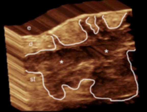 Hypoechoic fluid collection 3D ultrasound hidradenitis suppurativa image demonstrates a hypoechoic fluid collection with echoes (debris) in the subcutaneous tissue and dermis, also connected to the base of the hair follicles