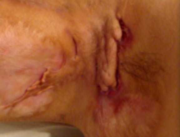 Hurley Stage III Clinical image of a hidradenitis suppurativa underarm case classified as Hurley stage III