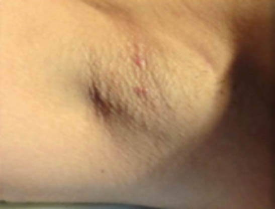Hurley Stage I Clinical image of a hidradenitis suppurativa underarm case classified as Hurley stage I