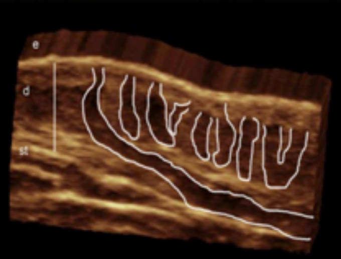 Hair follicles 3D ultrasound hidradenitis suppurativa image show involvement of multiple hair follicles