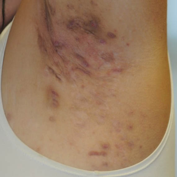 Hidradenitis Suppurativa Early Stages