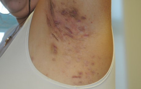 Hidradenitis suppurativa (HS) lesions underarm