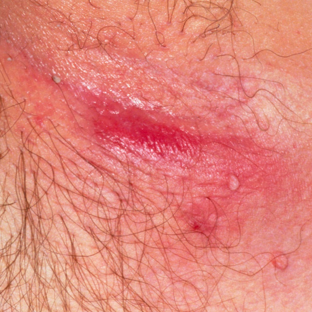 Image of female underarm with hidradenitis suppurativa Hurley Stage I