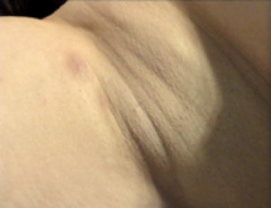 Clinical image of a hidradenitis suppurativa underarm case classified as Hurley stage I