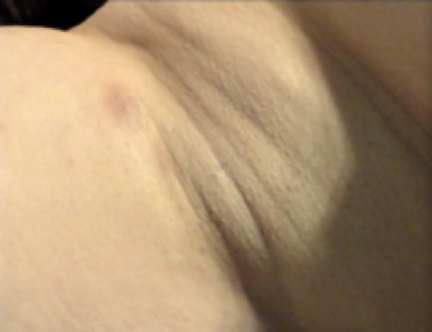 Hurley Stage I Clinical image of a hidradenitis suppurativa underarm case classified as Hurley stage I