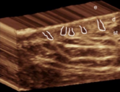 Hair follicle base 3D ultrasound hidradenitis suppurativa image demonstrates predominant enlargement of the base of the hair follicles in the deep portion of the dermis